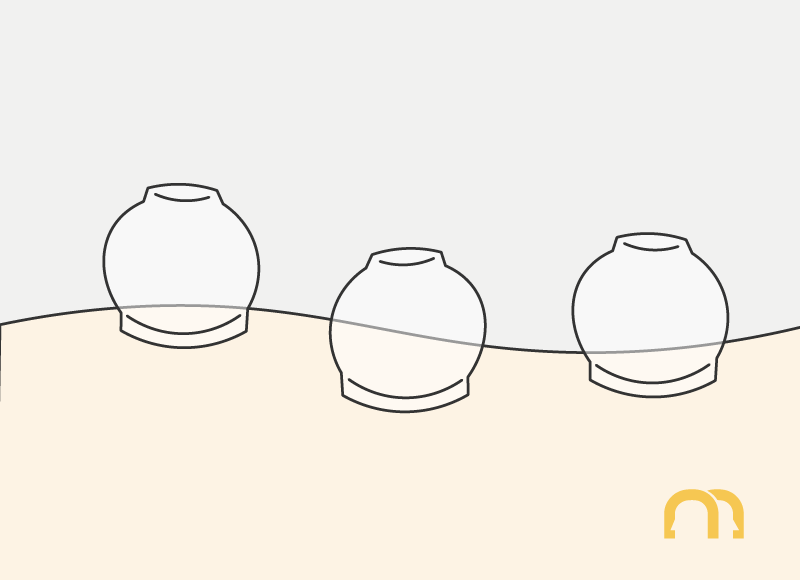 What is Cupping? | That's Mandarin Blog